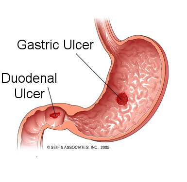 Ulcer Gastro Duodenal
